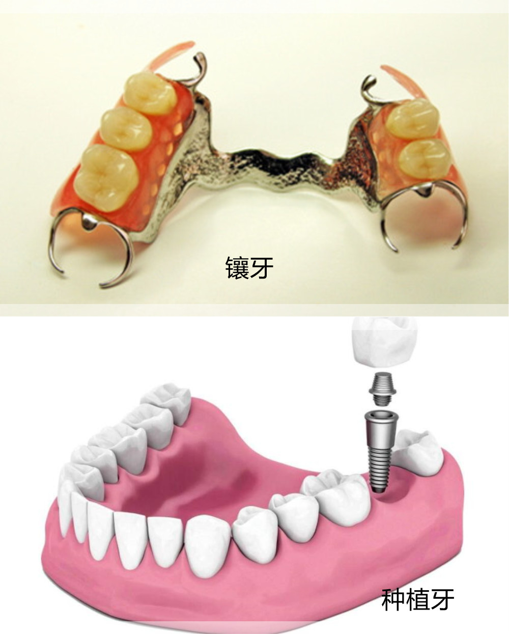 镶牙_副本