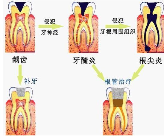 根尖炎