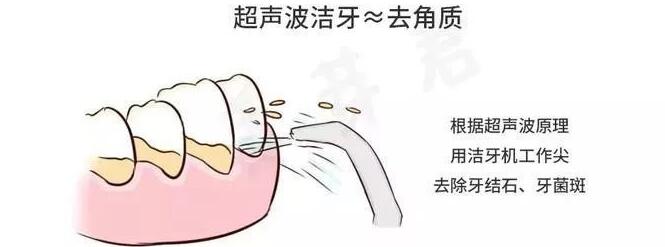 超声波洁牙